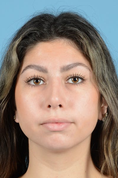 Rhinoplasty Before & After Gallery - Patient 108822 - Image 2