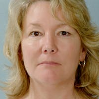Facelift Before & After Gallery - Patient 135346 - Image 1
