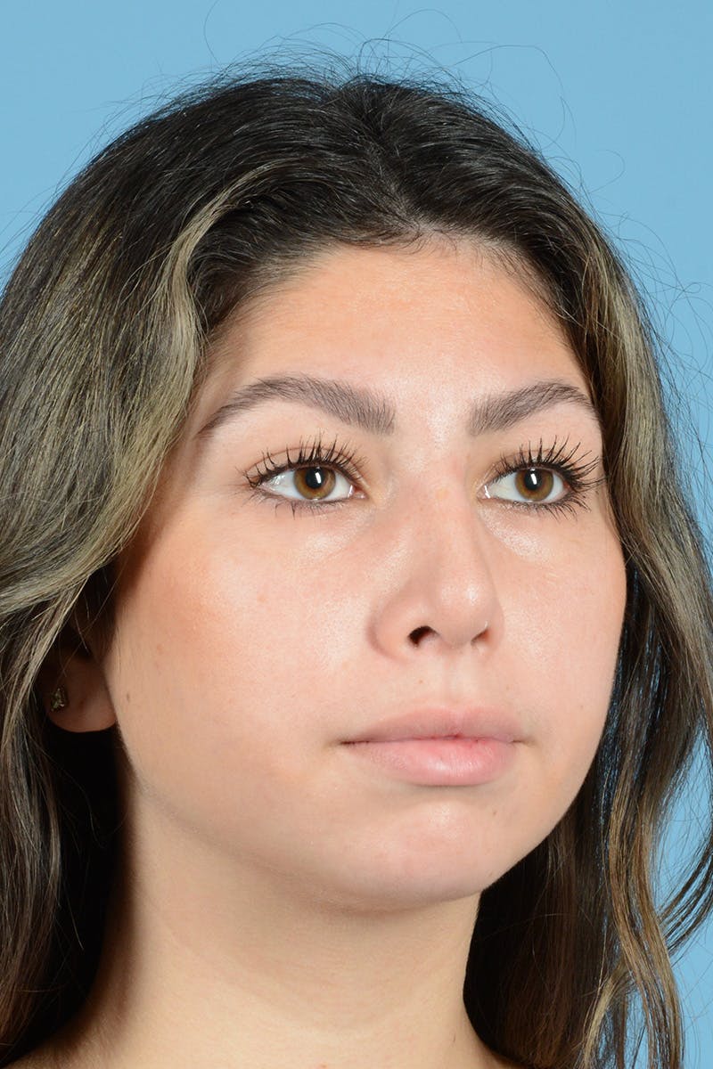 Rhinoplasty Before & After Gallery - Patient 108822 - Image 4