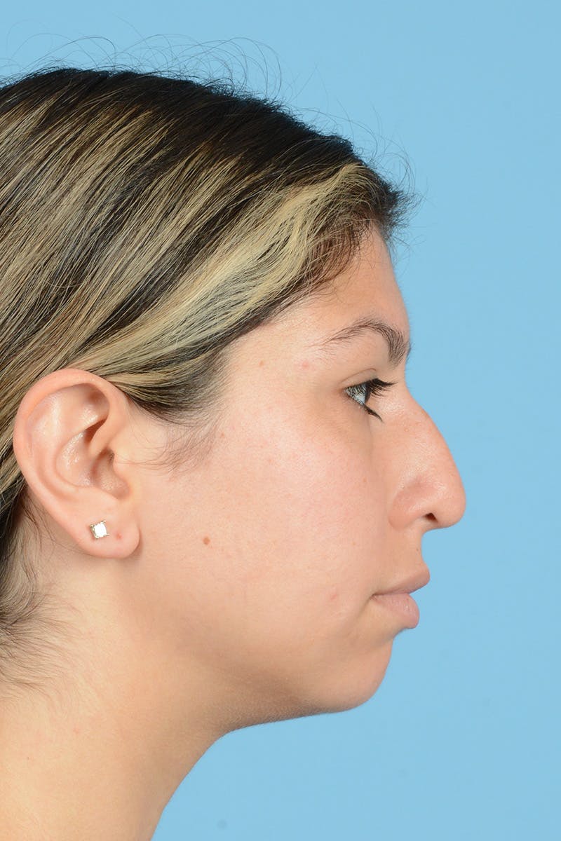 Rhinoplasty Before & After Gallery - Patient 108822 - Image 5