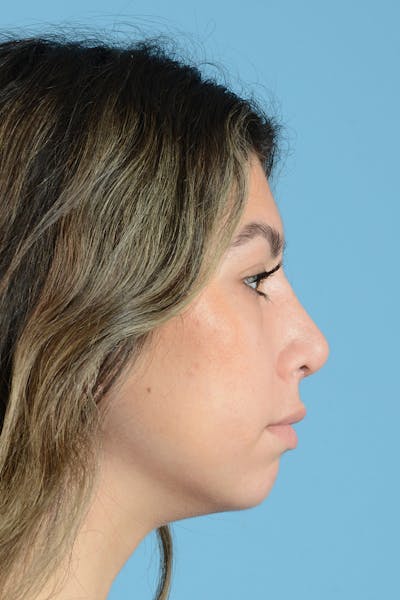 Rhinoplasty Before & After Gallery - Patient 108822 - Image 6