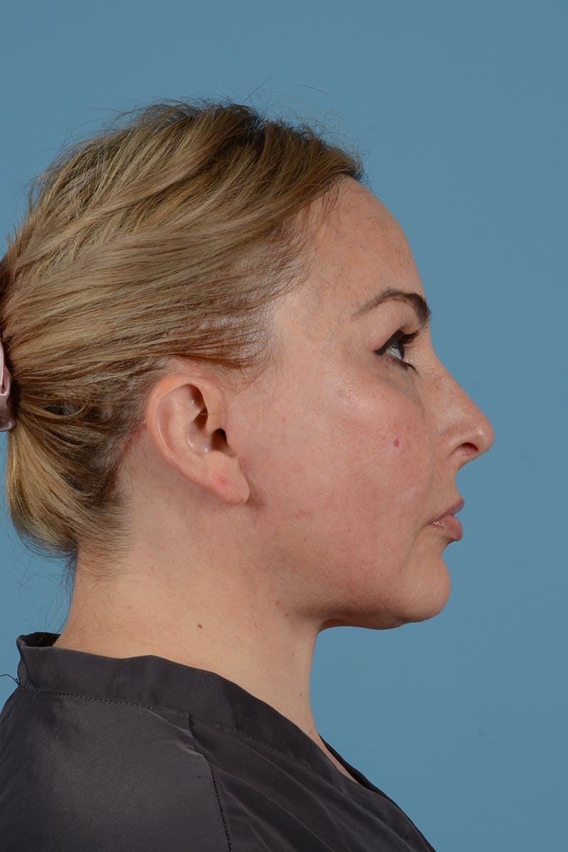 Skin Resurfacing Before & After Gallery - Patient 371664 - Image 8