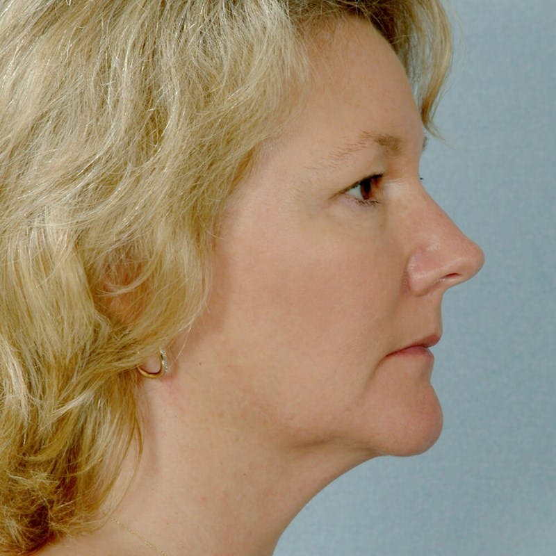 Facelift Before & After Gallery - Patient 135346 - Image 5