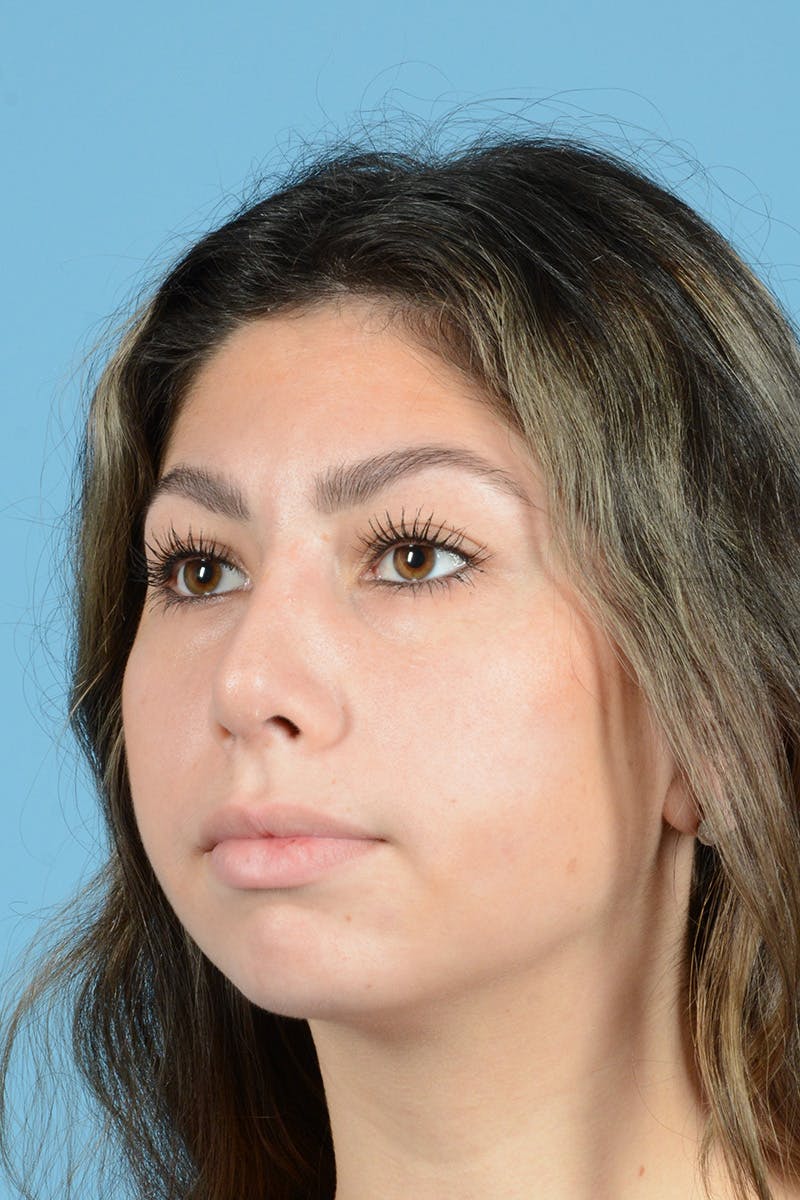 Rhinoplasty Before & After Gallery - Patient 108822 - Image 8