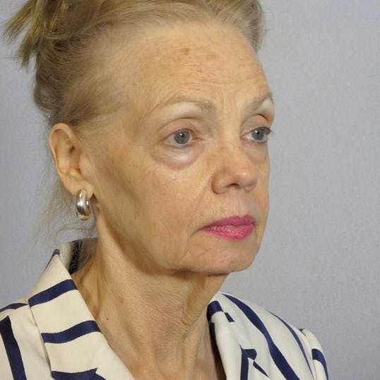 Neck Lift Before & After Gallery - Patient 102653 - Image 3