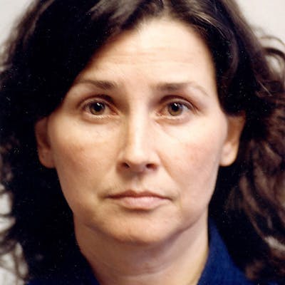 Facelift Before & After Gallery - Patient 784009 - Image 1