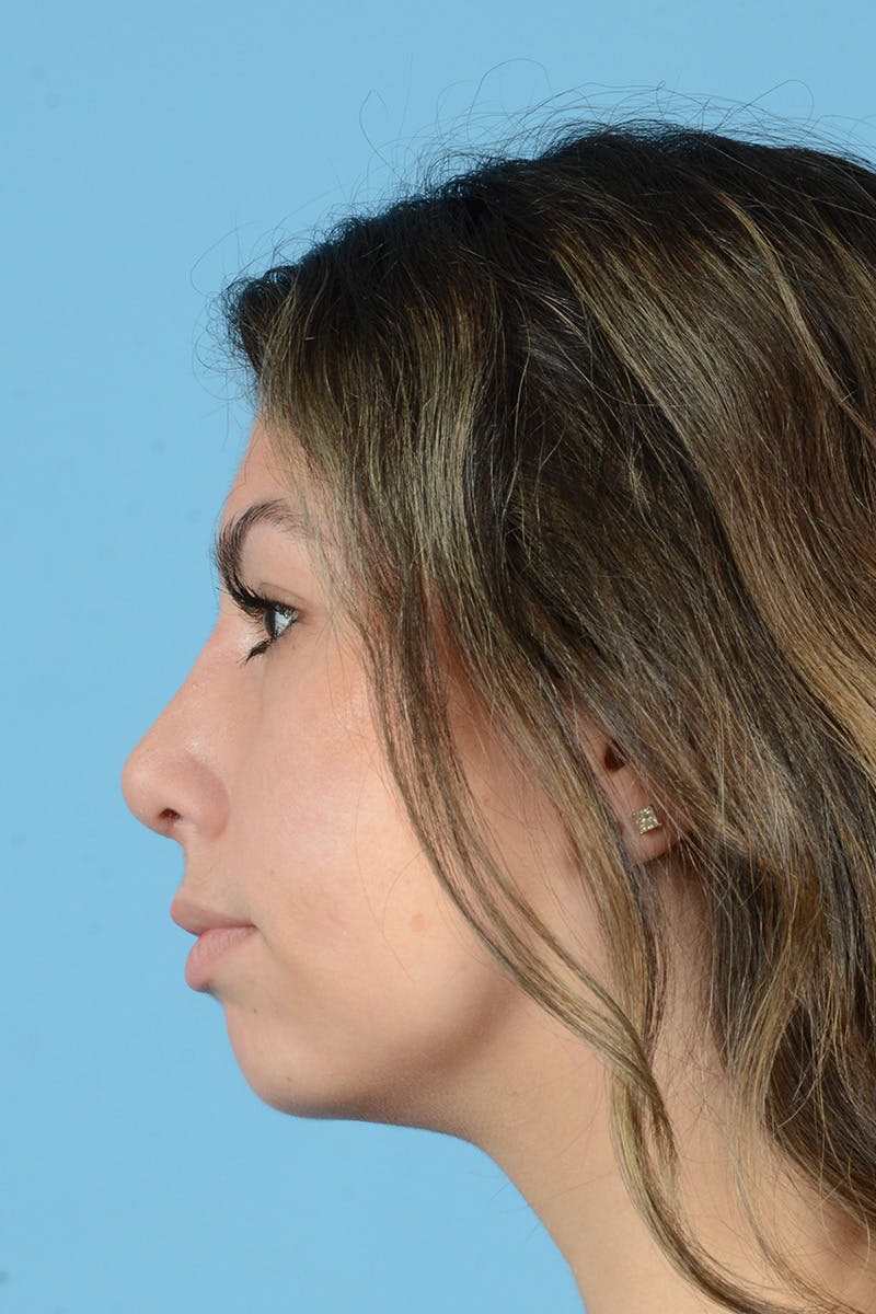 Rhinoplasty Before & After Gallery - Patient 108822 - Image 10