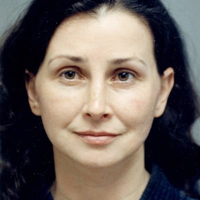Facelift Before & After Gallery - Patient 784009 - Image 2