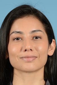 Rhinoplasty Before & After Gallery - Patient 280664 - Image 1