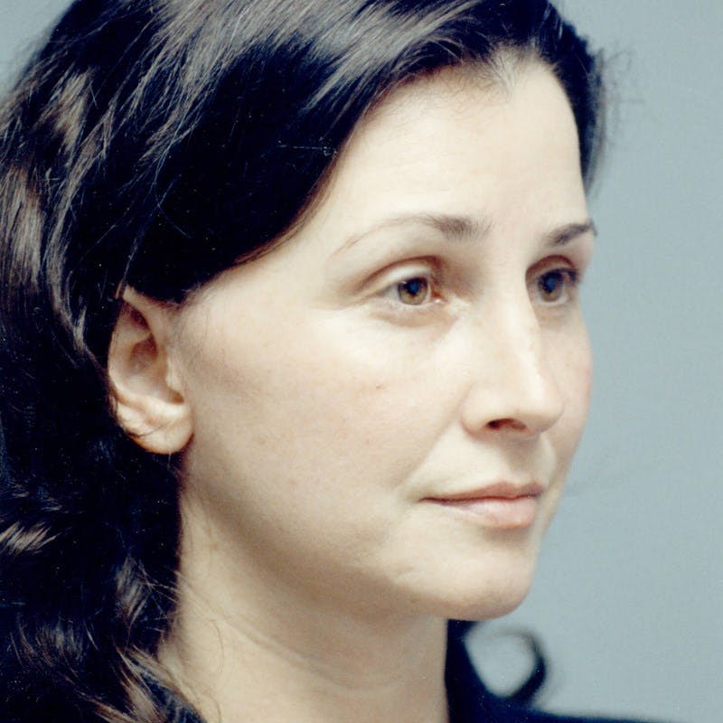 Facelift Before & After Gallery - Patient 784009 - Image 4