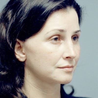 Facelift Before & After Gallery - Patient 784009 - Image 4