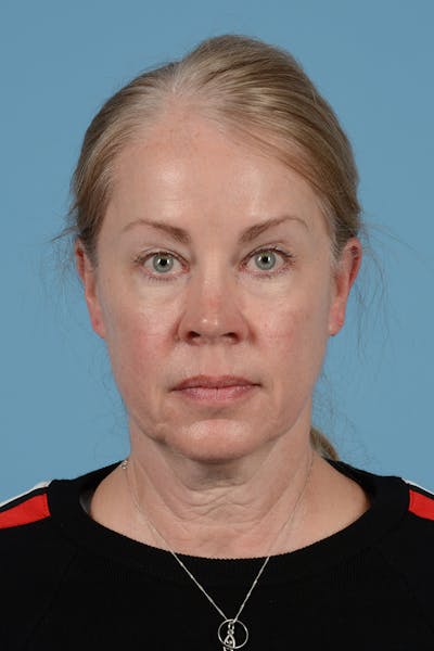 Skin Resurfacing Before & After Gallery - Patient 413682 - Image 1