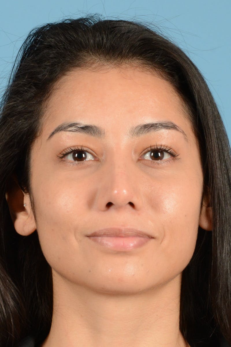 Rhinoplasty Before & After Gallery - Patient 280664 - Image 2