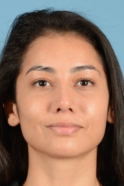 Rhinoplasty Before & After Gallery - Patient 280664 - Image 2