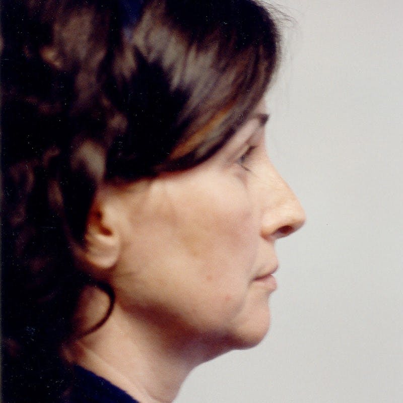 Facelift Before & After Gallery - Patient 784009 - Image 5