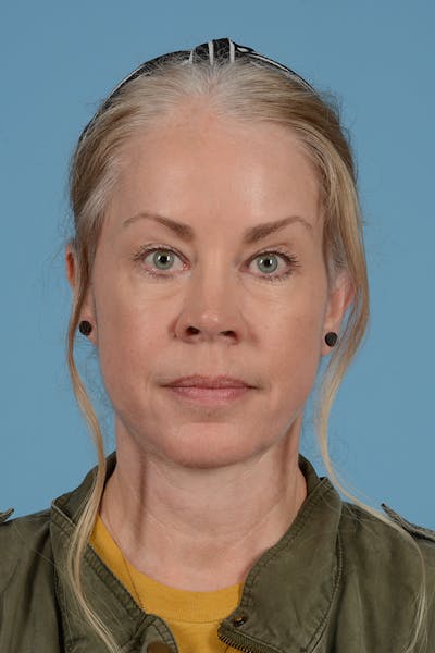 Skin Resurfacing Before & After Gallery - Patient 413682 - Image 2