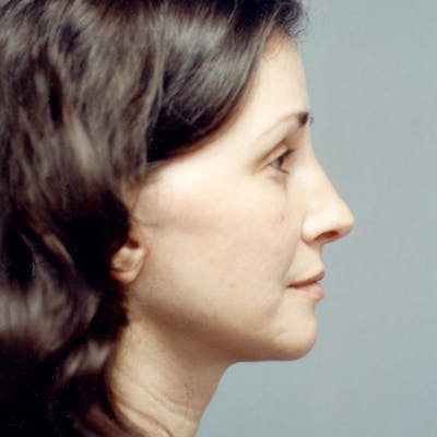 Facelift Before & After Gallery - Patient 784009 - Image 6