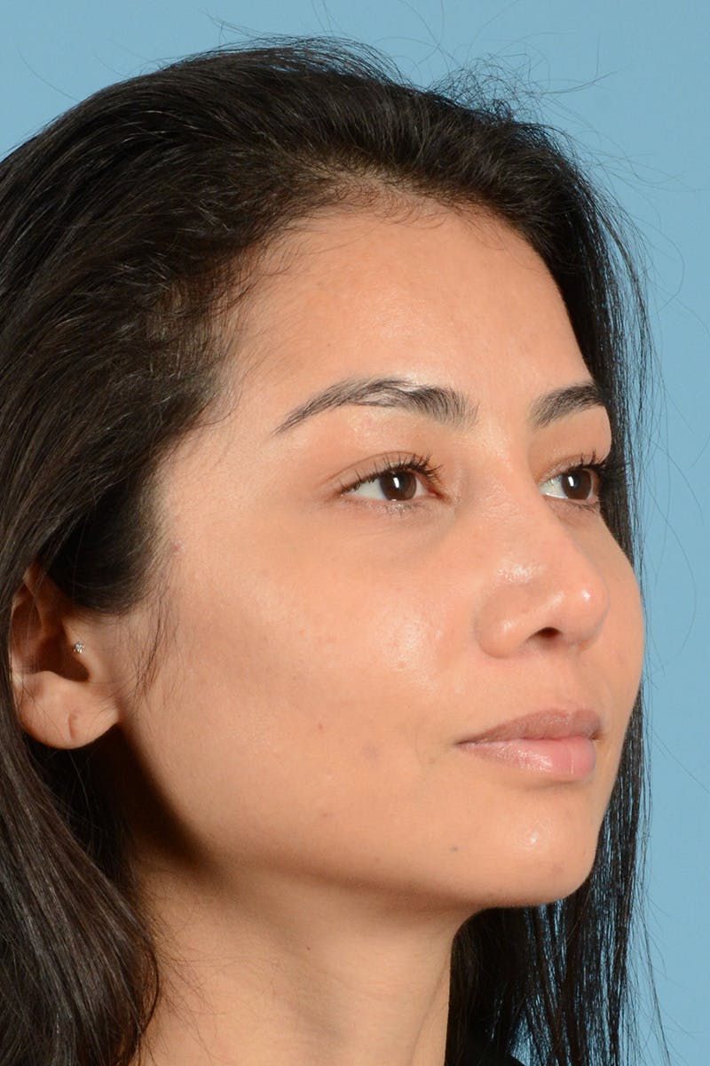 Rhinoplasty Before & After Gallery - Patient 280664 - Image 4