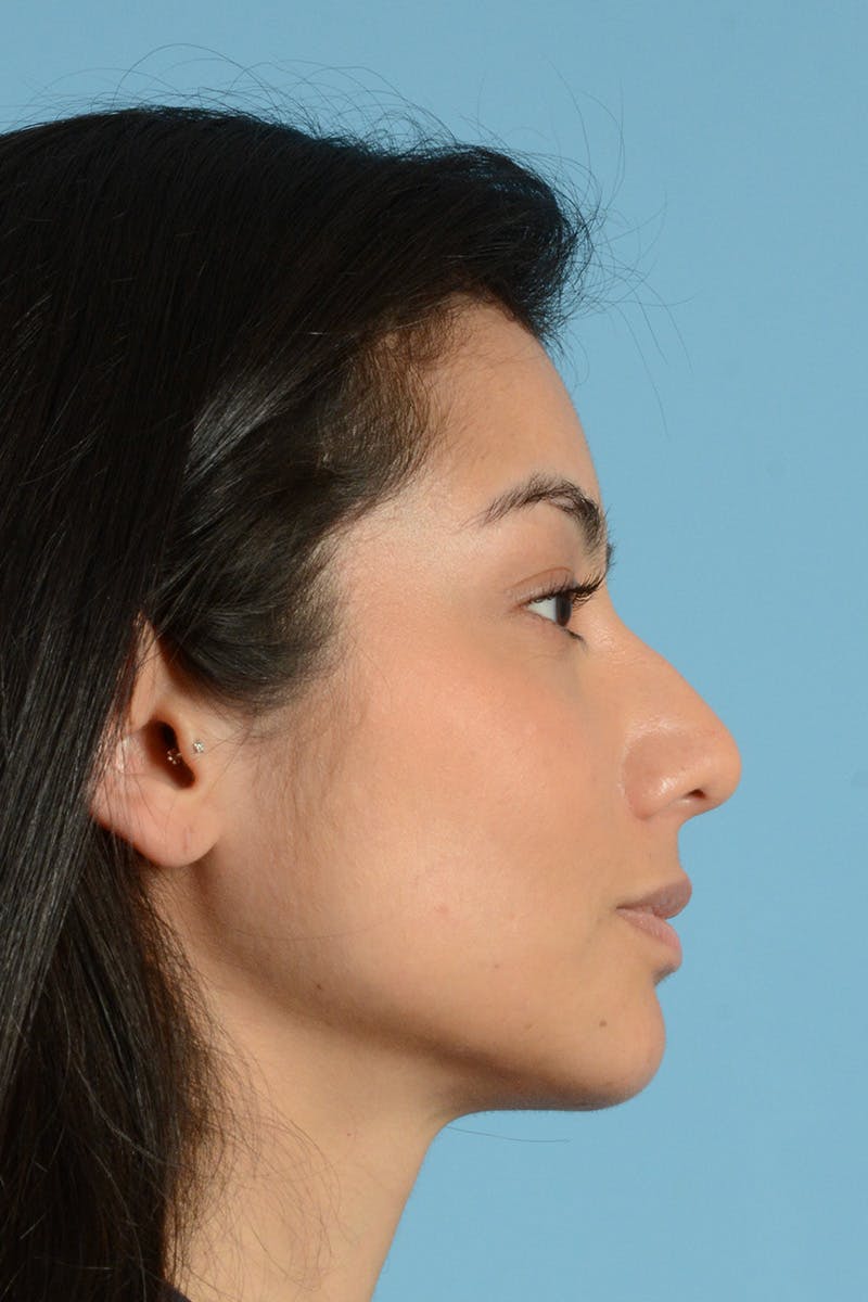 Rhinoplasty Before & After Gallery - Patient 280664 - Image 5