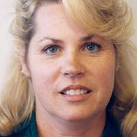 Facelift Before & After Gallery - Patient 154853 - Image 1