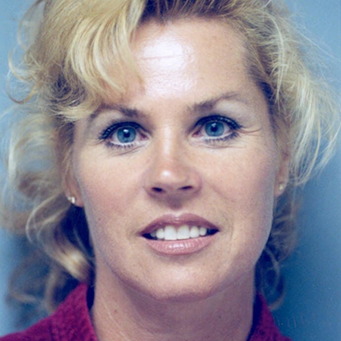 Facelift Before & After Gallery - Patient 154853 - Image 2