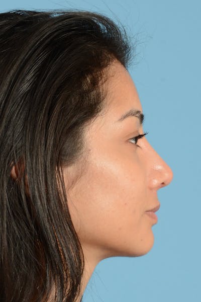 Rhinoplasty Before & After Gallery - Patient 280664 - Image 6
