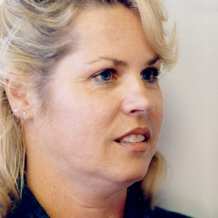 Facelift Before & After Gallery - Patient 154853 - Image 3