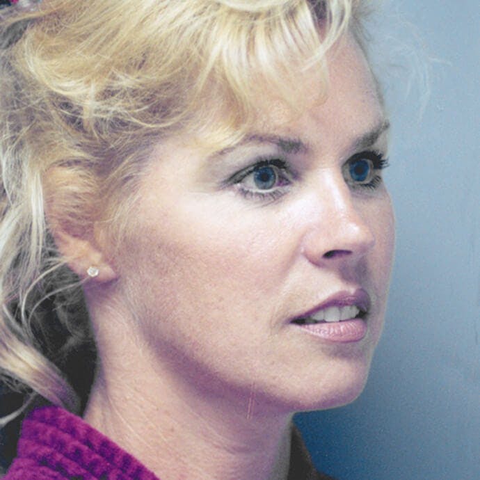 Facelift Before & After Gallery - Patient 154853 - Image 4