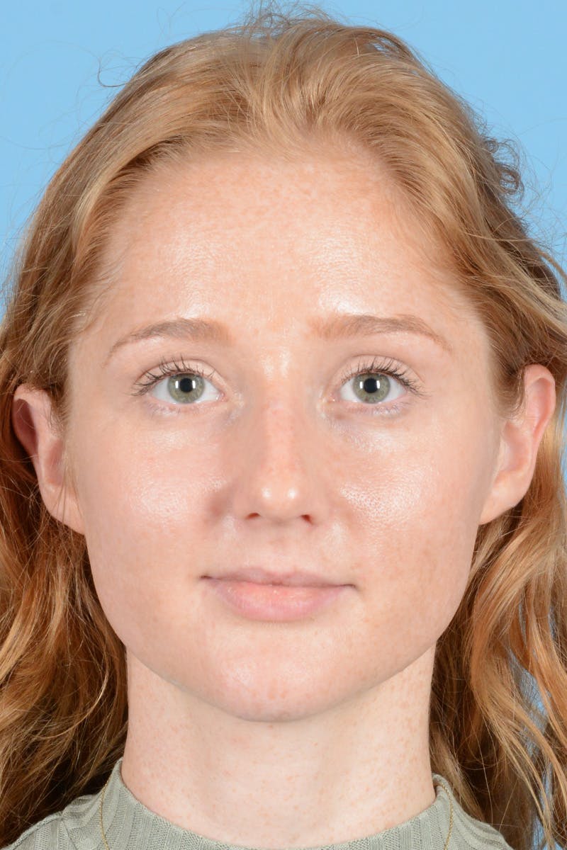 Rhinoplasty Before & After Gallery - Patient 275793 - Image 1