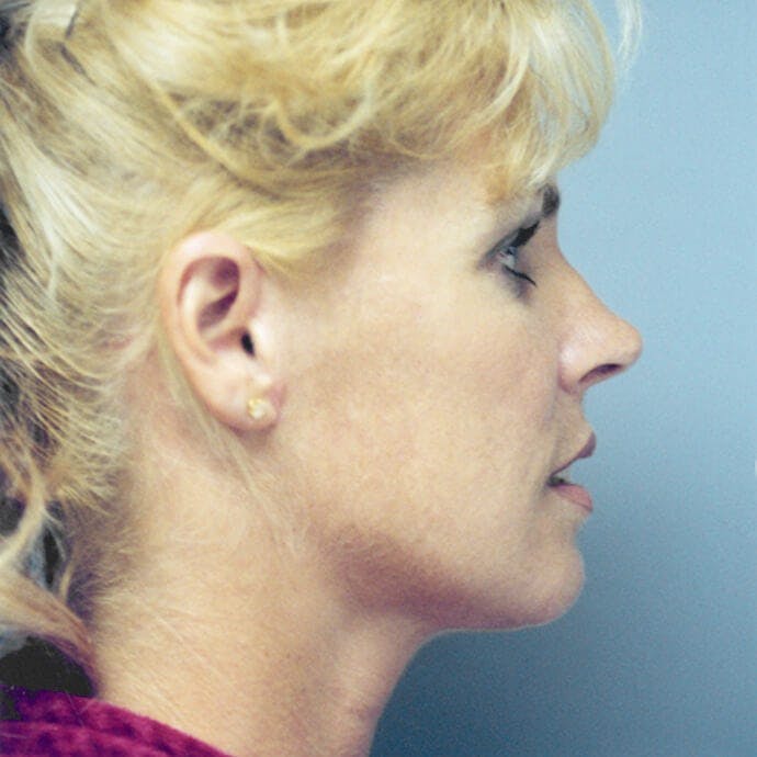 Facelift Before & After Gallery - Patient 154853 - Image 6