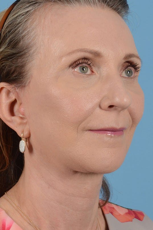 Neck Lift Before & After Gallery - Patient 128247 - Image 2