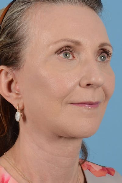 Neck Lift Before & After Gallery - Patient 128247 - Image 2