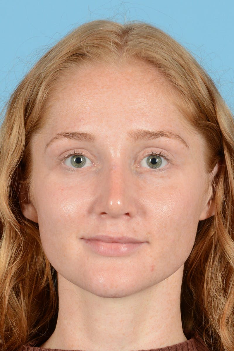 Rhinoplasty Before & After Gallery - Patient 275793 - Image 2