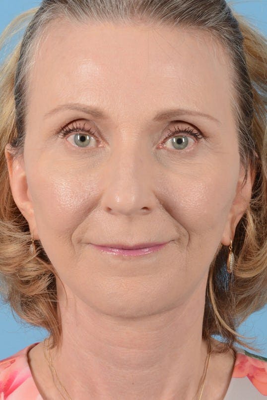 Neck Lift Before & After Gallery - Patient 128247 - Image 4