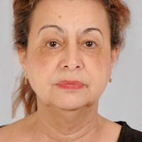 Facelift Before & After Gallery - Patient 381109 - Image 1