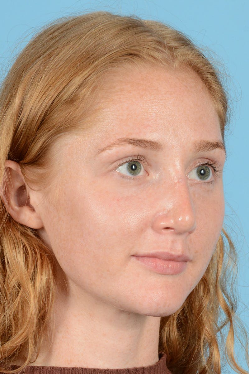 Rhinoplasty Before & After Gallery - Patient 275793 - Image 4