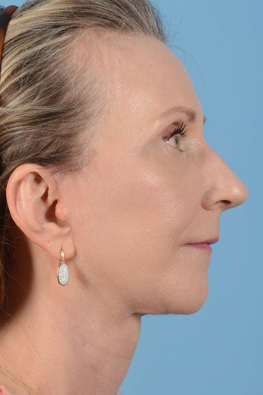 Neck Lift Before & After Gallery - Patient 128247 - Image 5