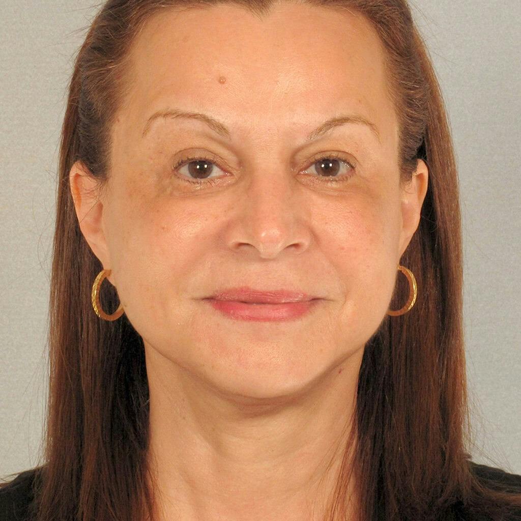 Facelift Before & After Gallery - Patient 381109 - Image 2