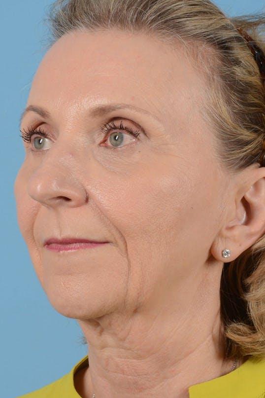 Neck Lift Before & After Gallery - Patient 128247 - Image 7