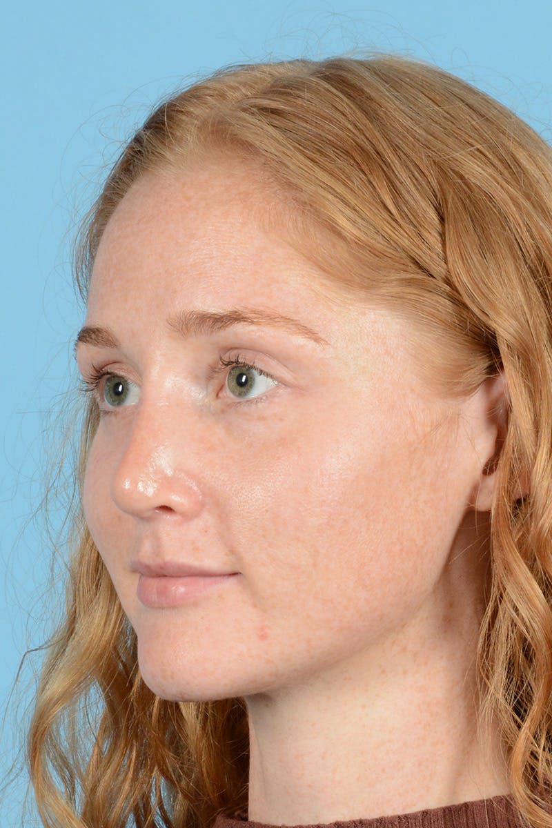 Rhinoplasty Before & After Gallery - Patient 275793 - Image 8