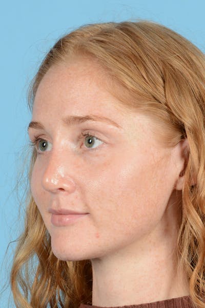 Rhinoplasty Before & After Gallery - Patient 275793 - Image 8