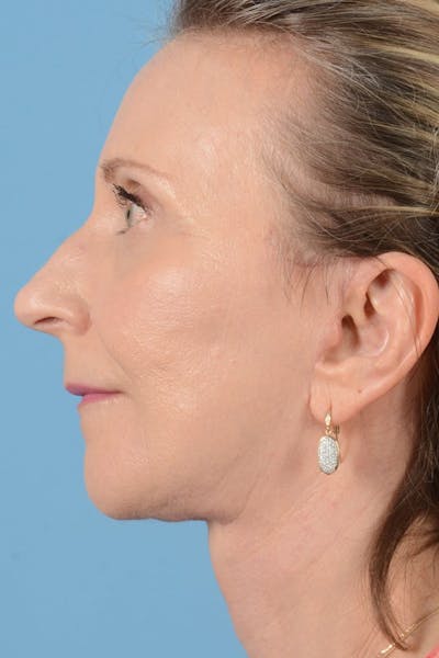 Neck Lift Before & After Gallery - Patient 128247 - Image 10