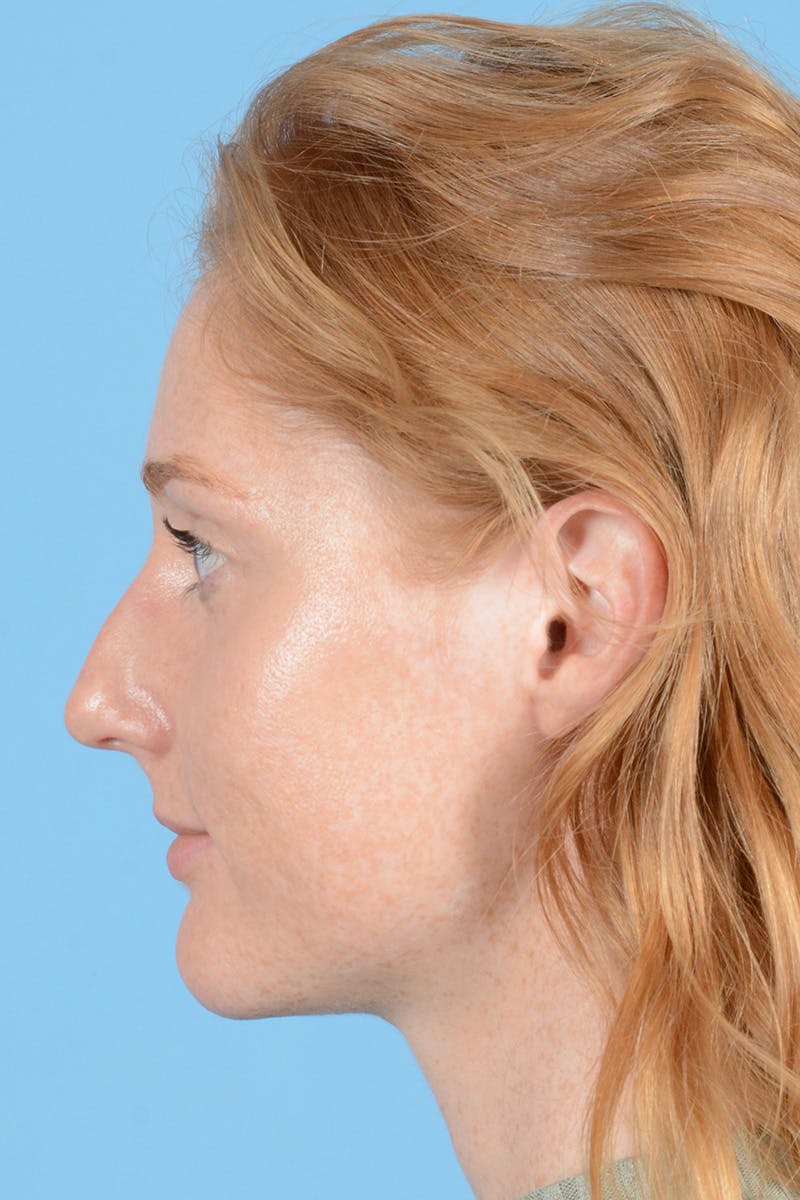 Rhinoplasty Before & After Gallery - Patient 275793 - Image 9