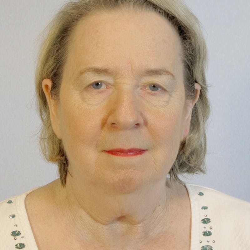 Facelift Before & After Gallery - Patient 391503 - Image 1