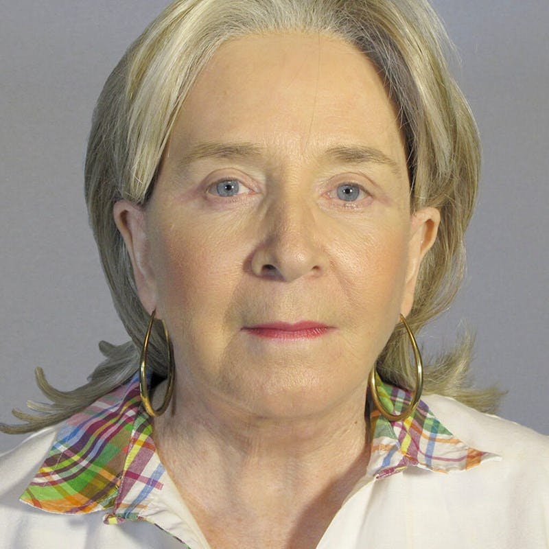 Facelift Before & After Gallery - Patient 391503 - Image 2