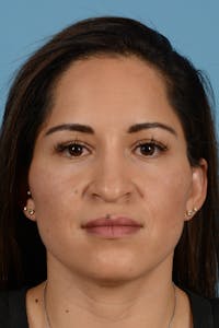 Rhinoplasty Before & After Gallery - Patient 221419 - Image 1