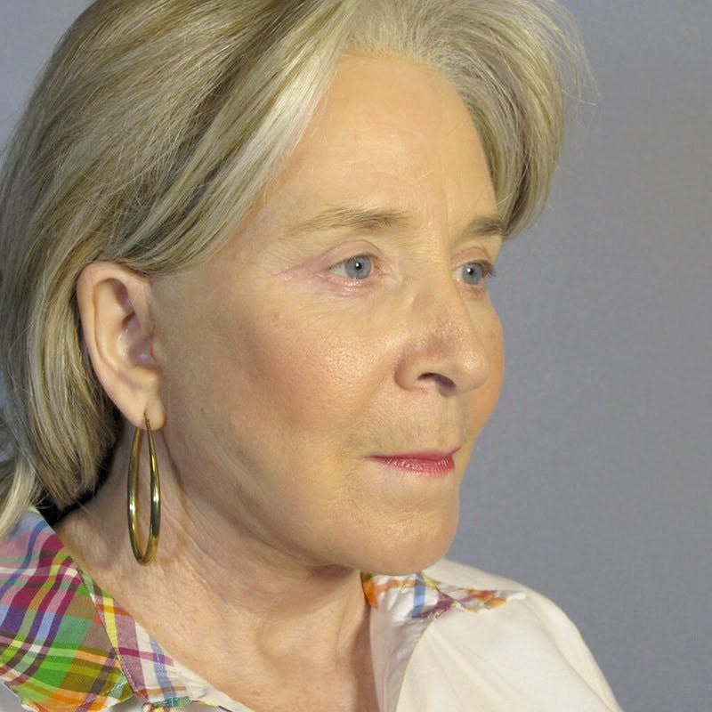 Facelift Before & After Gallery - Patient 391503 - Image 4