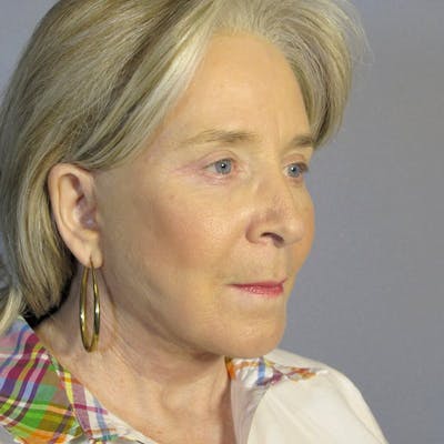 Facelift Before & After Gallery - Patient 391503 - Image 4