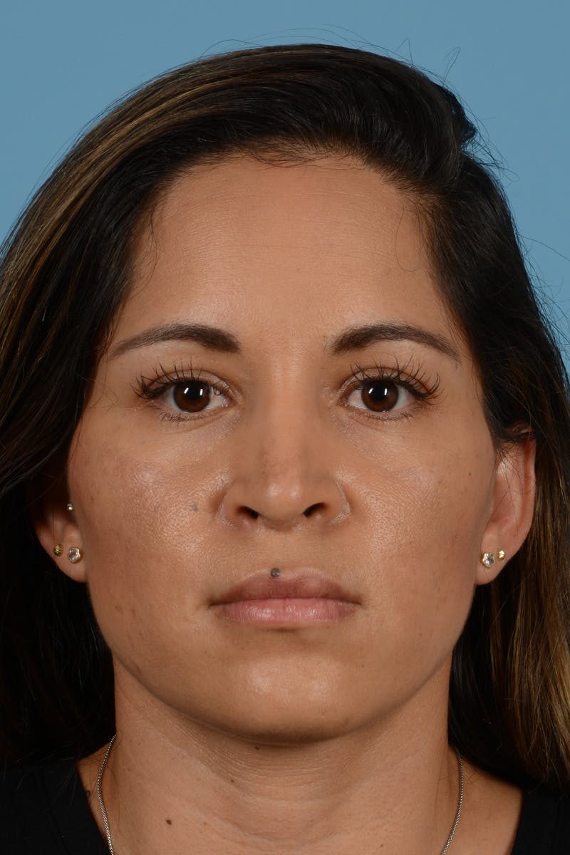 Rhinoplasty Before & After Gallery - Patient 221419 - Image 2