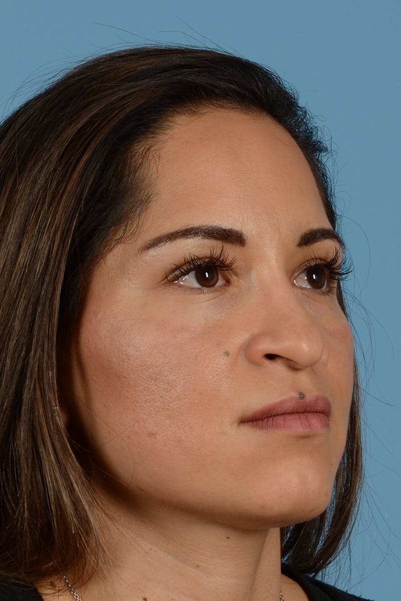 Rhinoplasty Before & After Gallery - Patient 221419 - Image 3